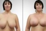 Zmenšenie prsníkov s implantátom - zadarmo & skvelý výsledok!